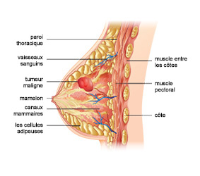 Diagramme du sein avec une tumeur cancéreuse